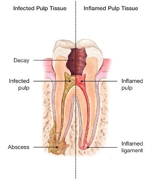 root canal