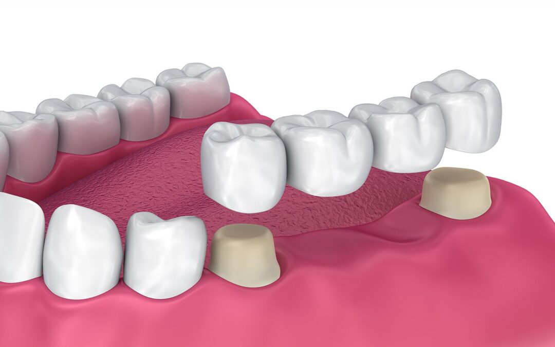 dental bridge queens